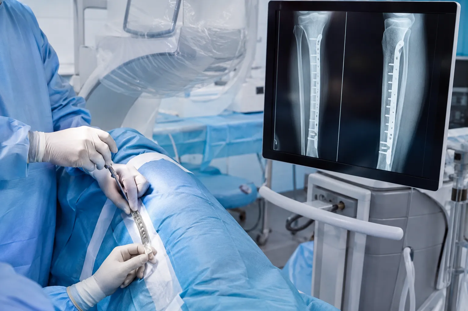 Fracture Surgeries What Patients Should Understand Before Fixation Procedures