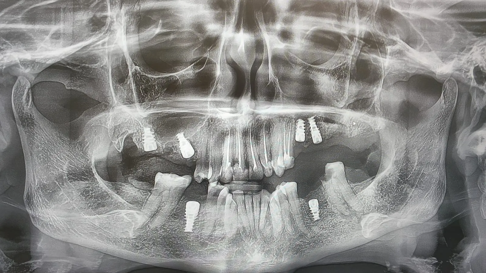 What Actually Happens During a Dental Implant Consultation?
