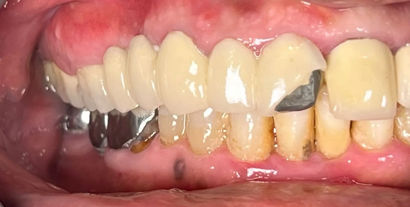 A Broken Tooth Doesn’t Always Hurt — But It Still Needs Attention