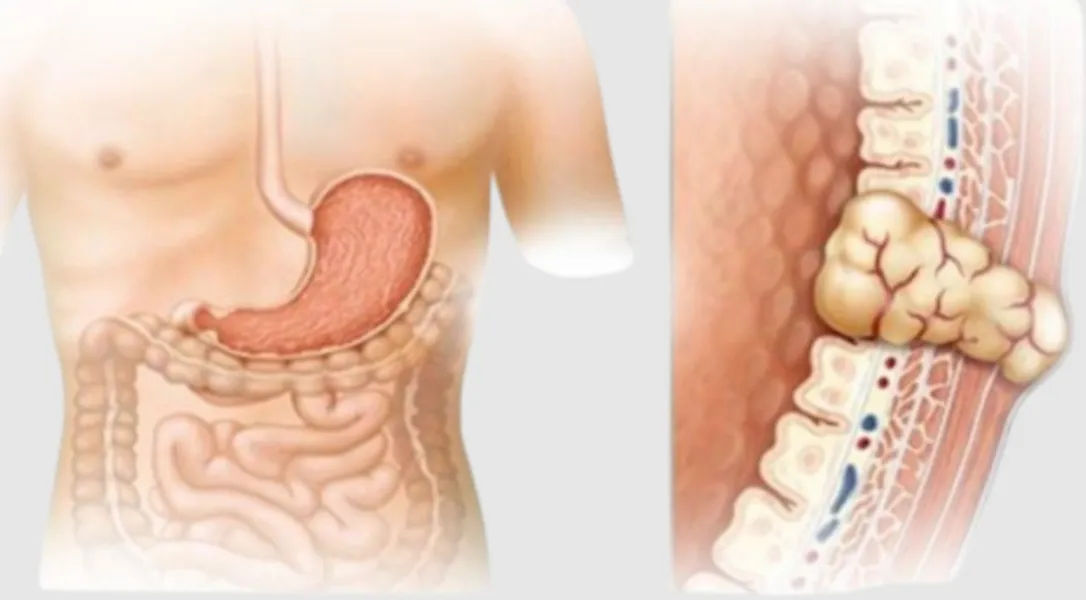 Gastrointestinal Stromal Tumors Require More Than Routine Abdominal Surgery