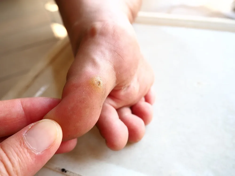 When Wart Removal Treatment Becomes a Practical Dermatology Option
