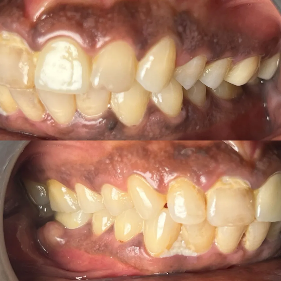 Pain When Biting? Your Tooth May Need More Than Pain Relief
A tooth that hurts only when you bite c...