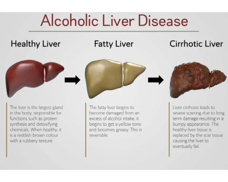 Alcohol Related Liver Disease Often Develops Long Before Symptoms Appear