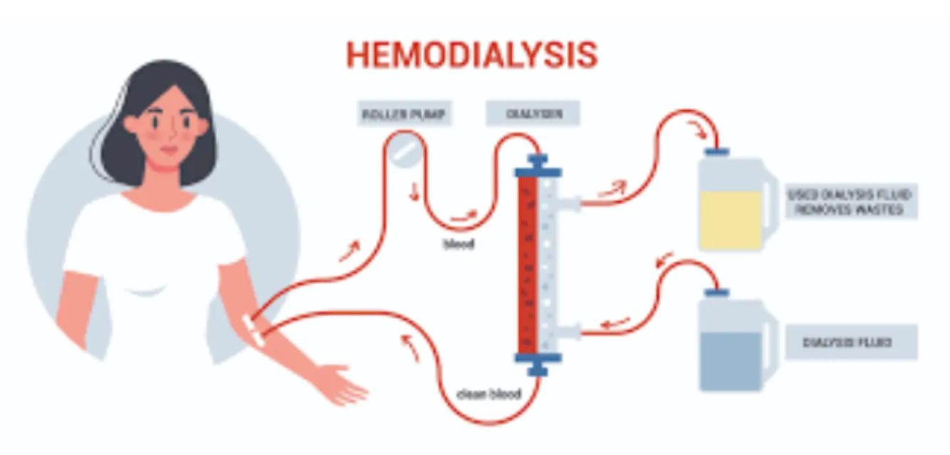 Hemodialysis Explained for Patients and Families in Pune