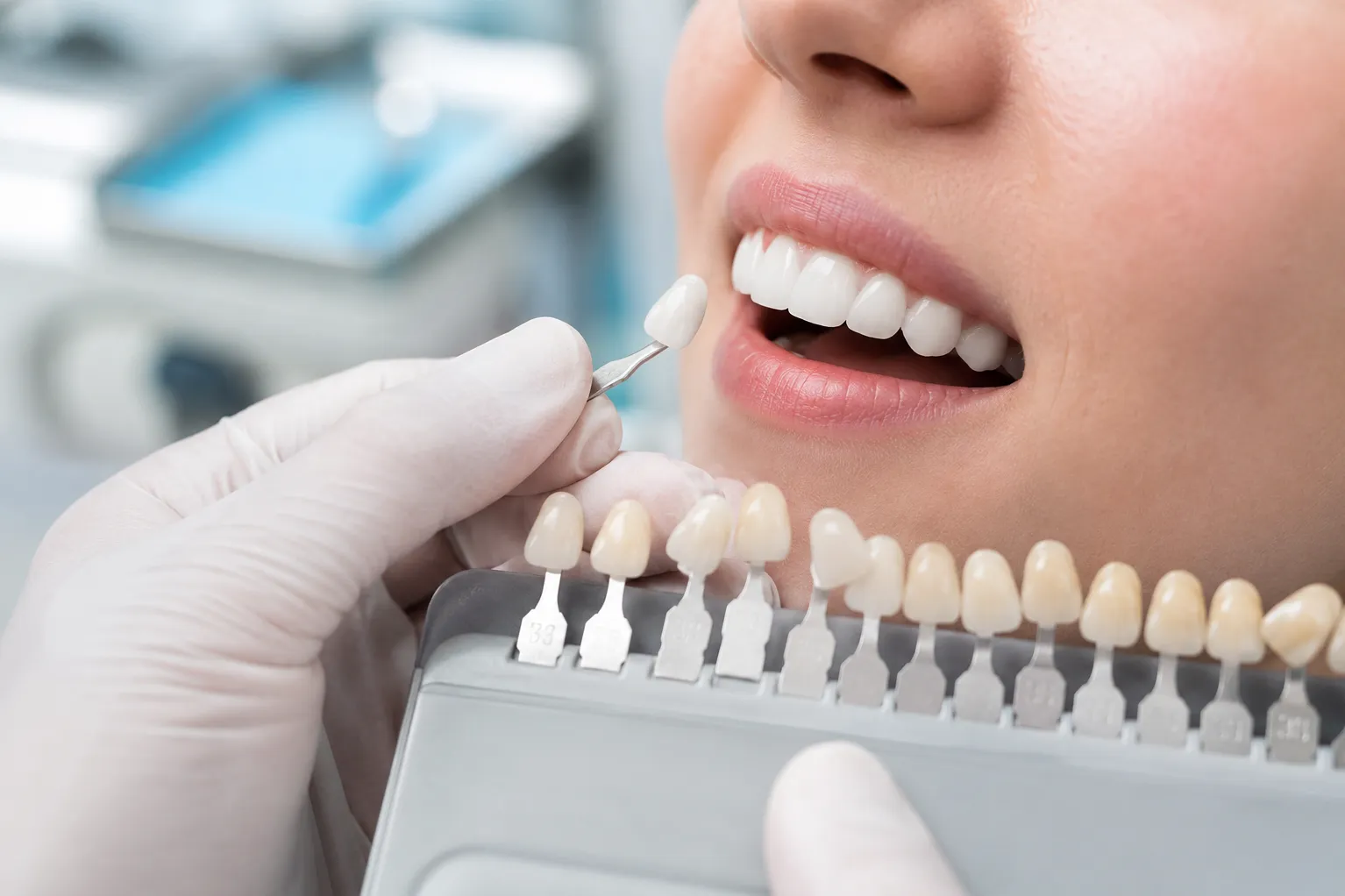 Why Composite Restorations Need More Than a Good Shade Match