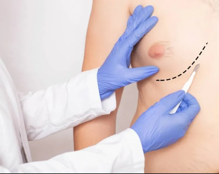 Gynaecomastia in Men: When Enlarged Male Breast Tissue May Need Evaluation