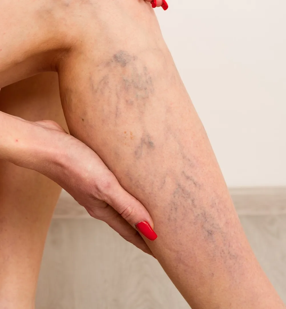 Varicose Veins Treatment Hospital in Dhankawadi/Katraj/Bibwewadi/Undri/Wanowrie/Swargate/Pune