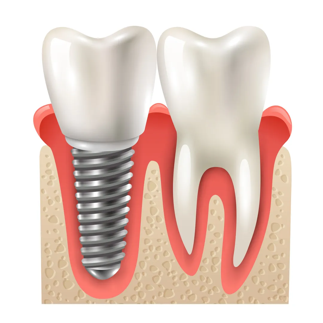 Dental Implants in Delhi Understanding How Missing Teeth Can Be Replaced