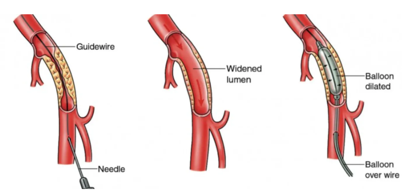Peripheral Angiography in Kalyan: Why This Test Is Important Before Vascular Treatment