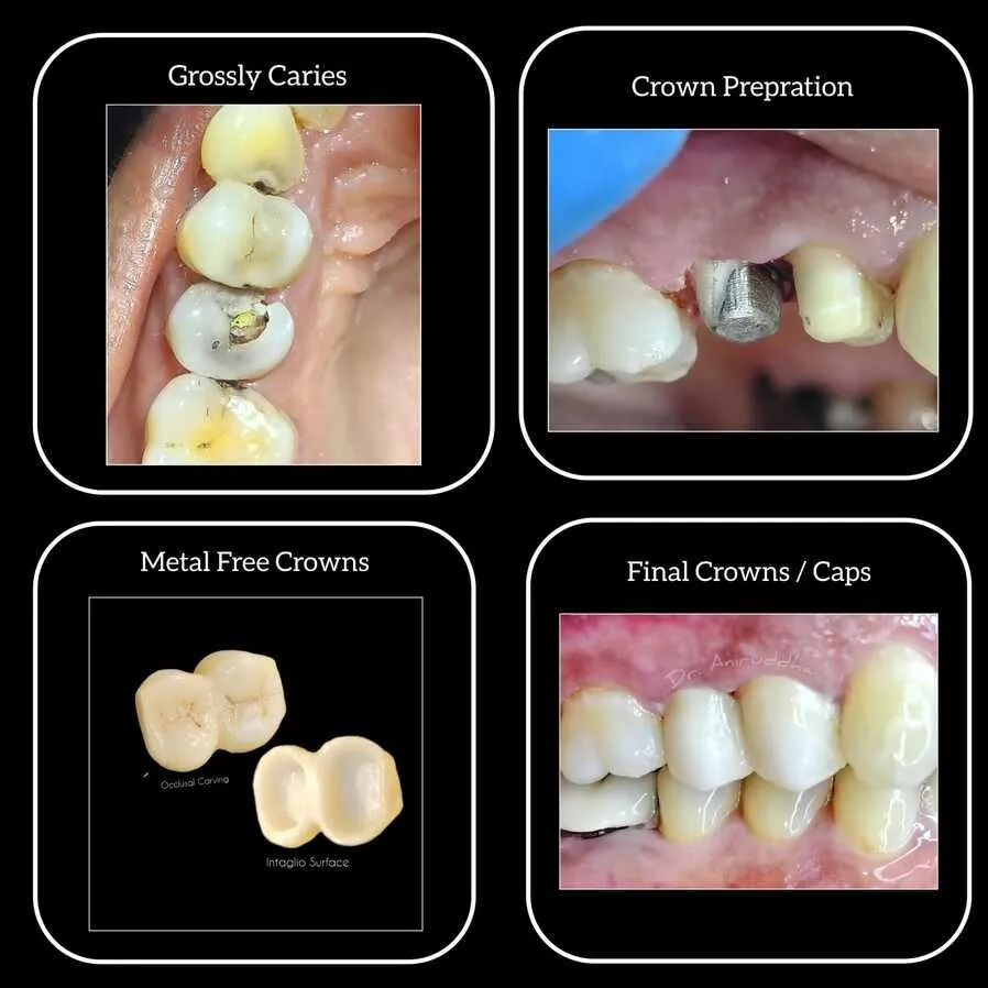 Post and Core ceramic cap for badly broken/cavity tooth
