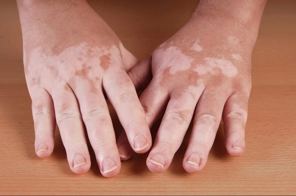 Vitiligo Treatment in Mumbai: What White Patches on the Skin May Mean