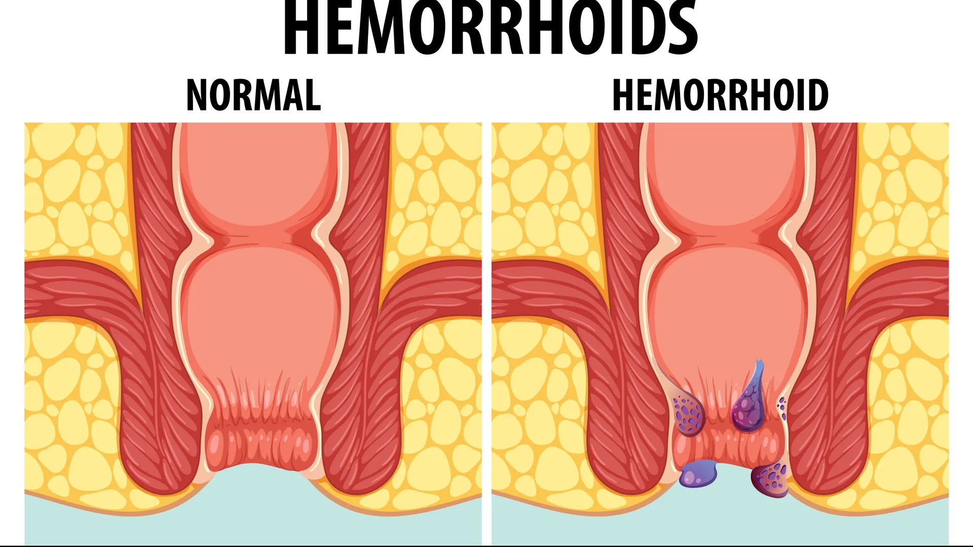 Hemorrhoids That Keep Returning: Common Reasons Symptoms Come Back