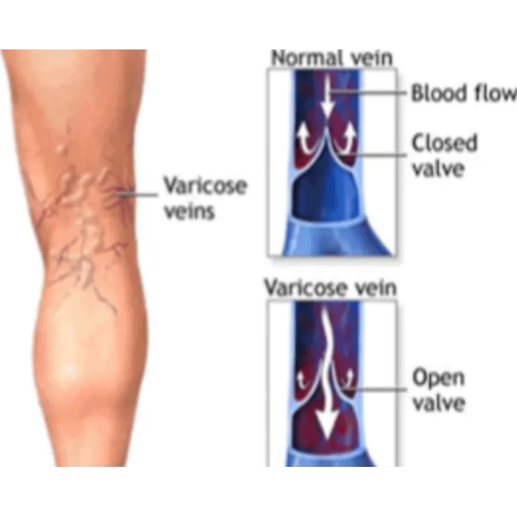 Laparoscopic Varicose Vein Ligation What to Check Before Choosing Treatment