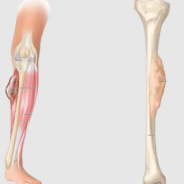 Choosing Surgical Care for Soft Tissue Sarcomas Before the First Operation