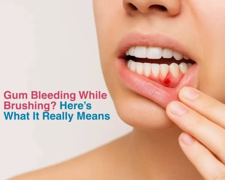 Do You Avoid Brushing Thoroughly Because Your Gums Bleed?
