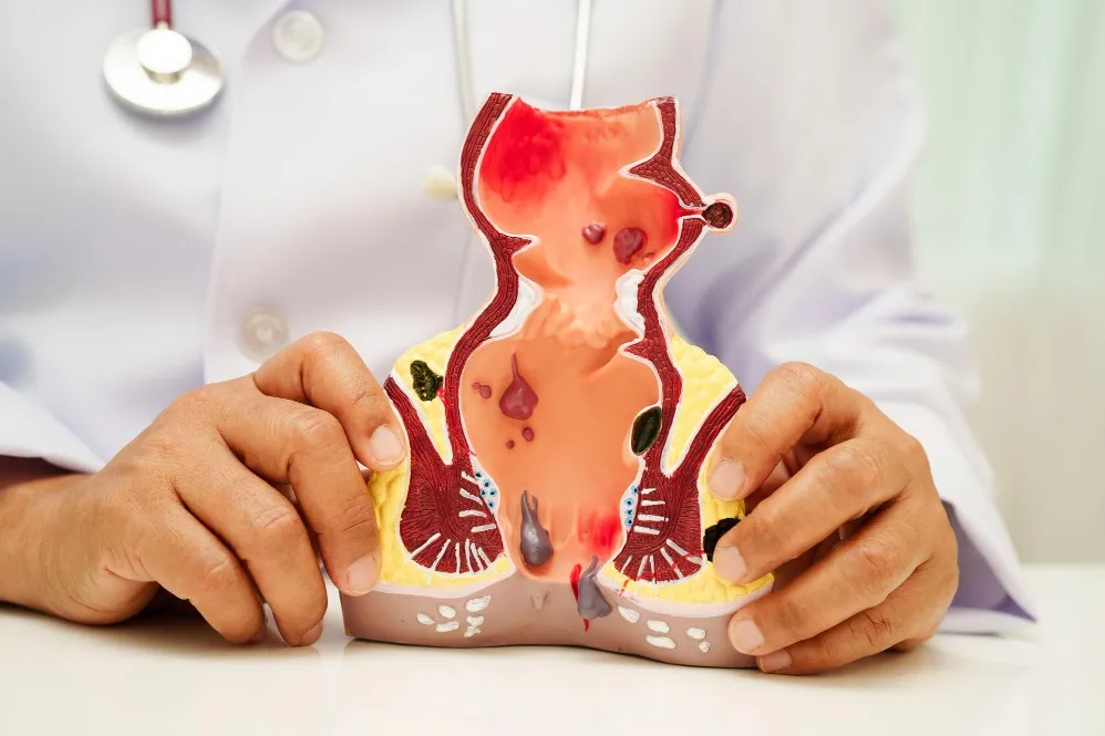 Fistula Treatment Explained When Recurrent Discharge Needs Surgical Evaluation