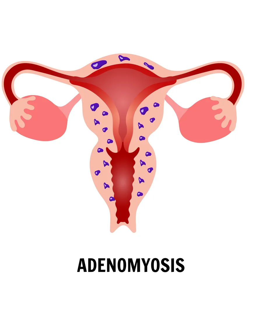 Connecting Pelvic Symptoms With Whole-Person Care for Adenomyosis
