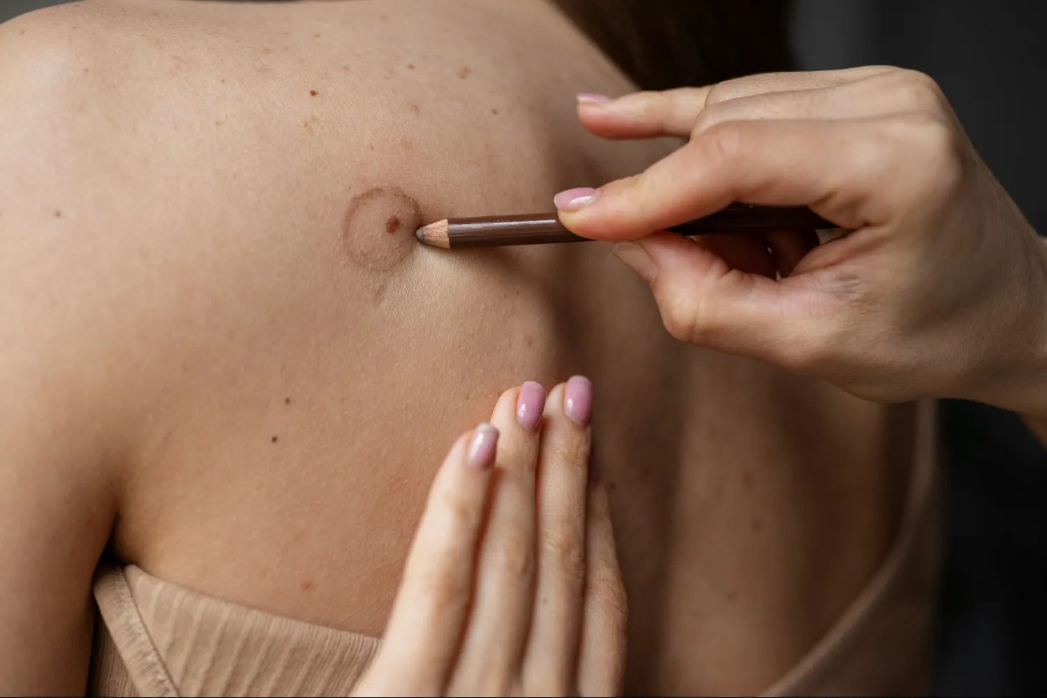 Skin Tags Removal Treatment Specialist Advice Before Choosing Removal