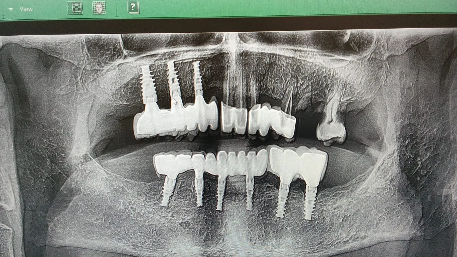 DENTAL IMPLANTS — MYTH vs FACT is