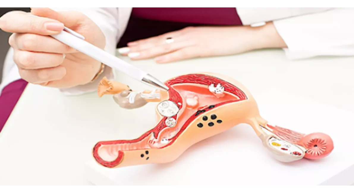 What Women Should Know Before Having an HSG Test for Fertility Evaluation