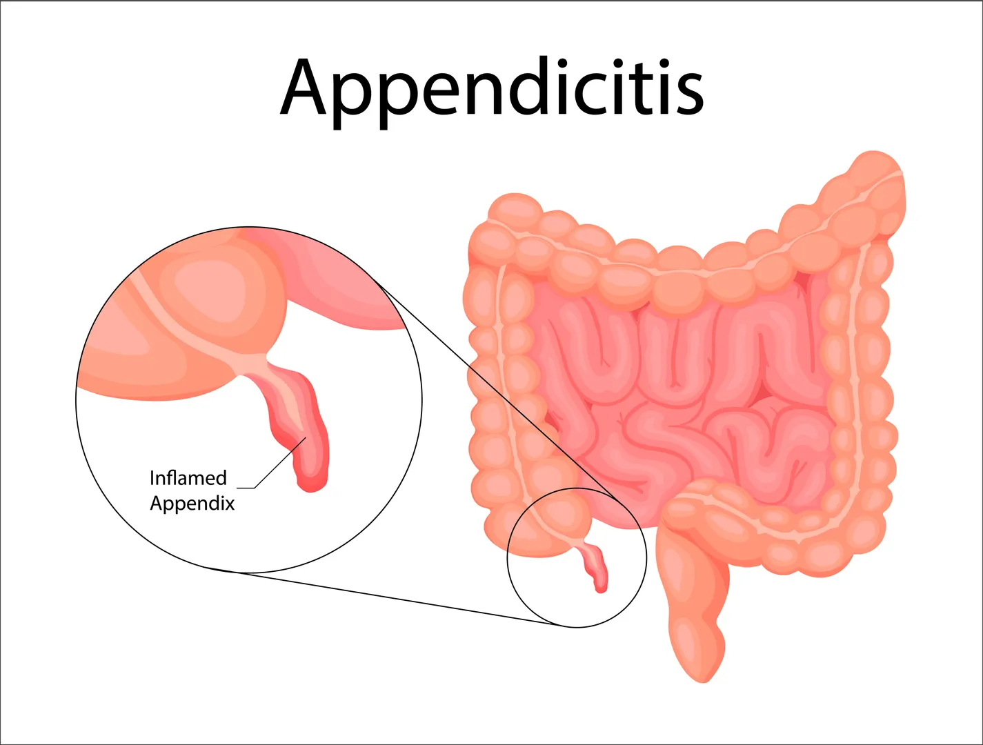 Appendix Treatment Hospital in Dhankawadi/Katraj/Bibwewadi/Kondhwa/Undri/Wanowrie/Swargate/Pune