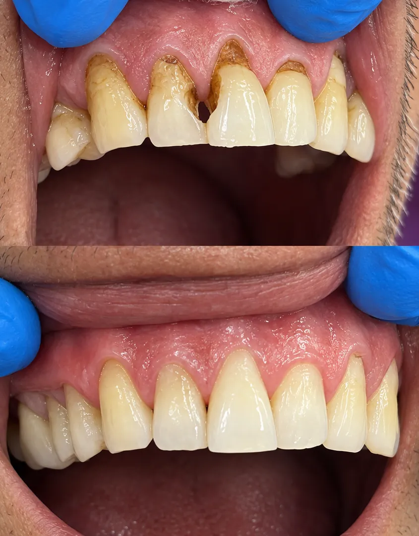 Composite Build-Up for Cavities: Restore Your Smile Naturally