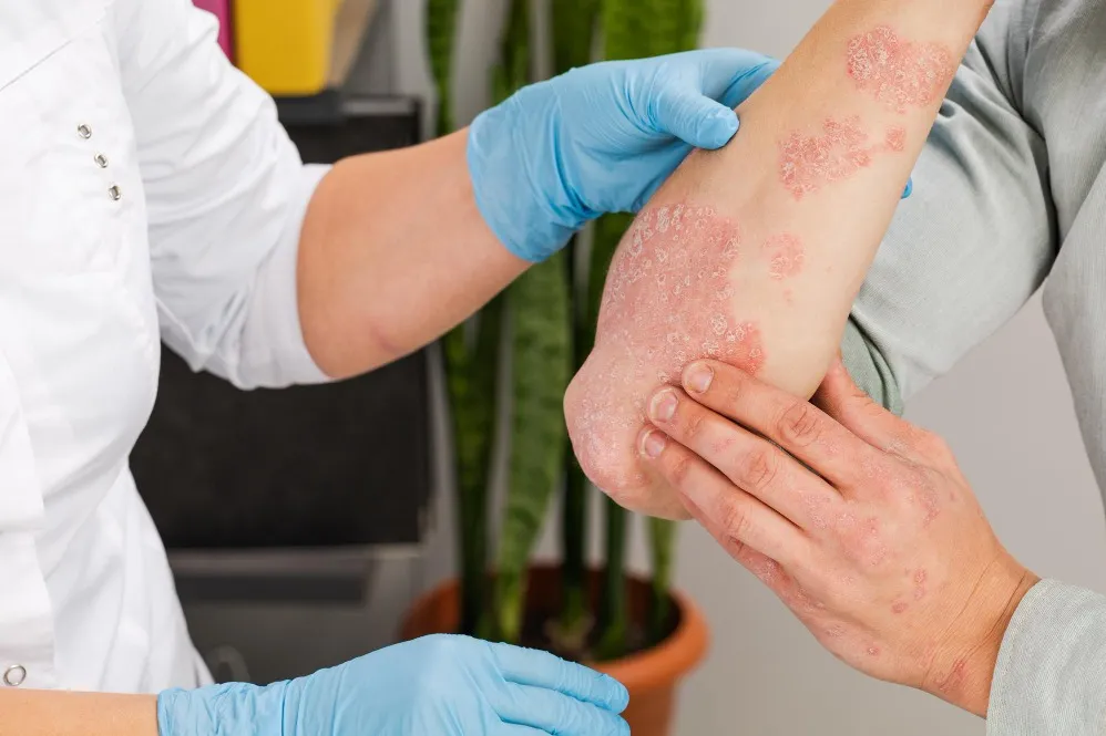 Eczema Treatment in Mumbai: Everyday Habits That Can Help Protect Sensitive Skin