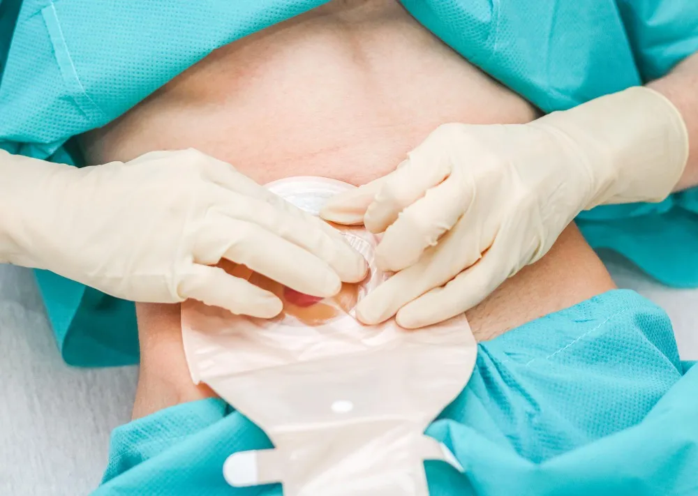 Choosing a Hernia Surgeon What Patients Should Check Before Treatment