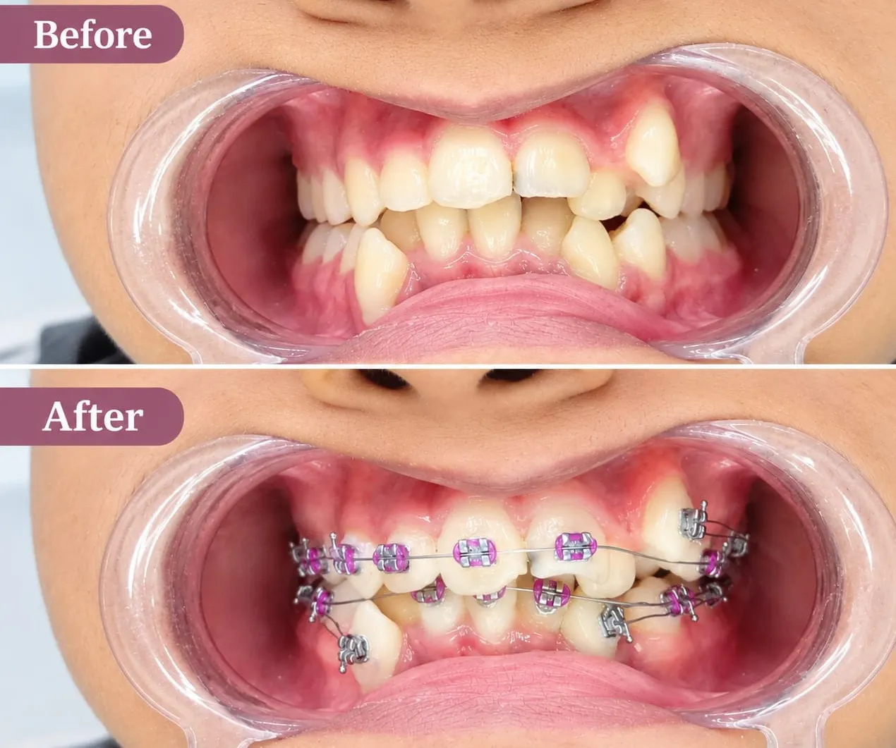 Braces Treatment In Vashi