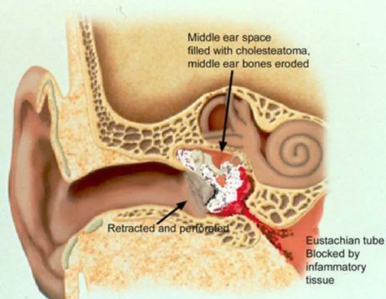 Mastoidectomy in Lalbaug Understanding Surgery for Persistent Mastoid Ear Disease