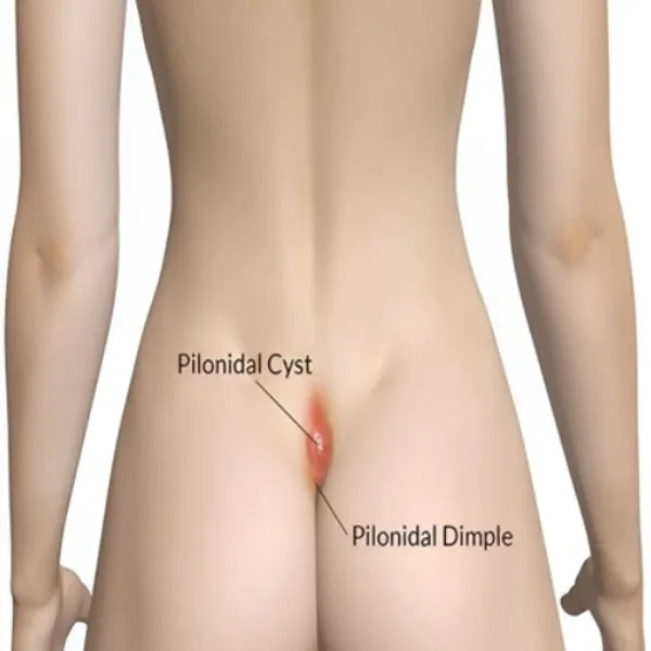 Pilonidal Sinus Treatment Why Repeated Pain and Discharge Should Not Be Ignored