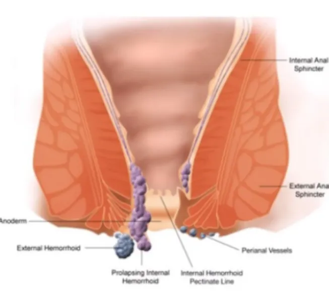 Piles Treatment Common Mistakes That Can Delay Proper Relief