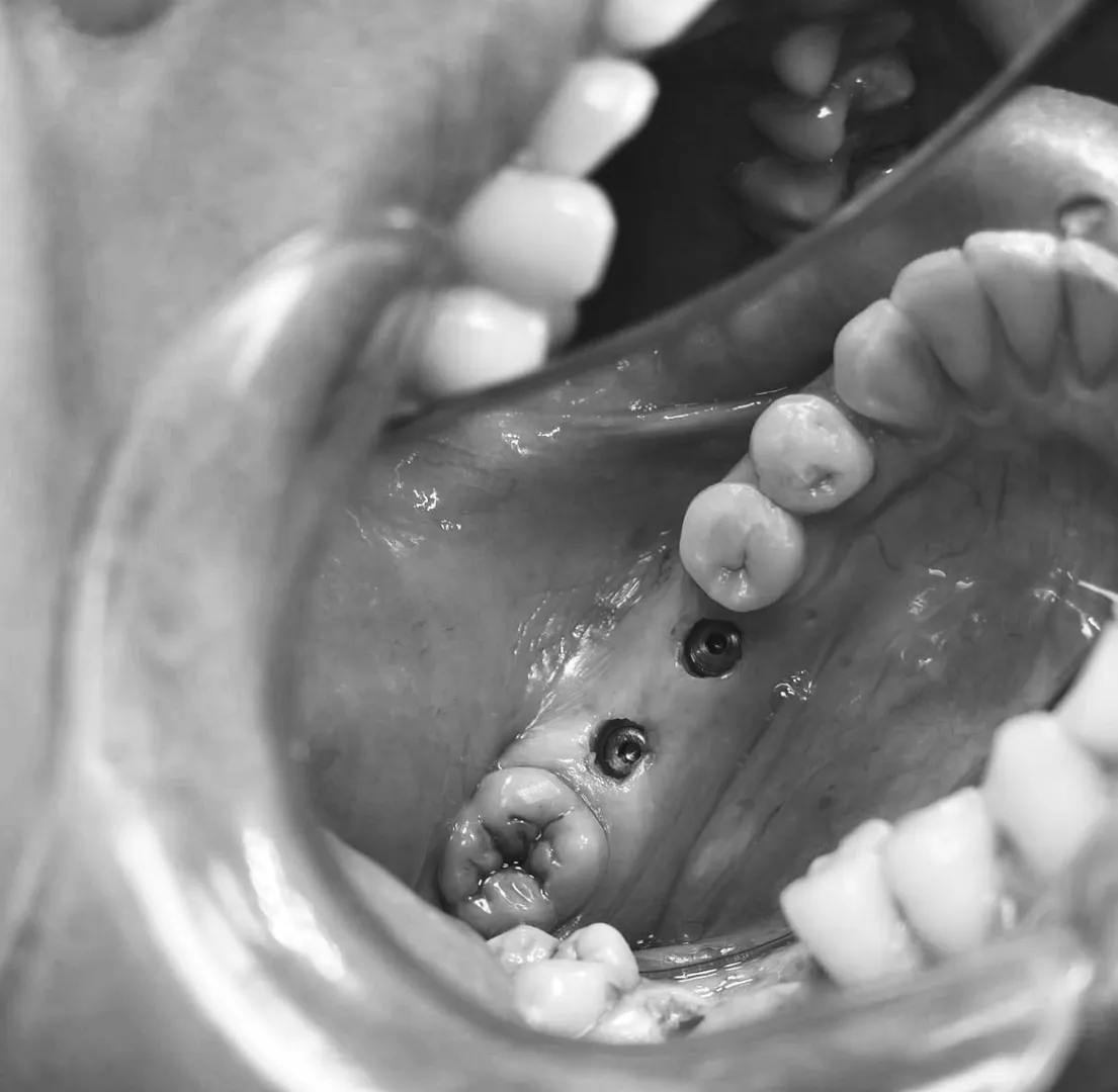 Can Dental Implants Be Done in One Day? Same-Day Implant Treatment Explained