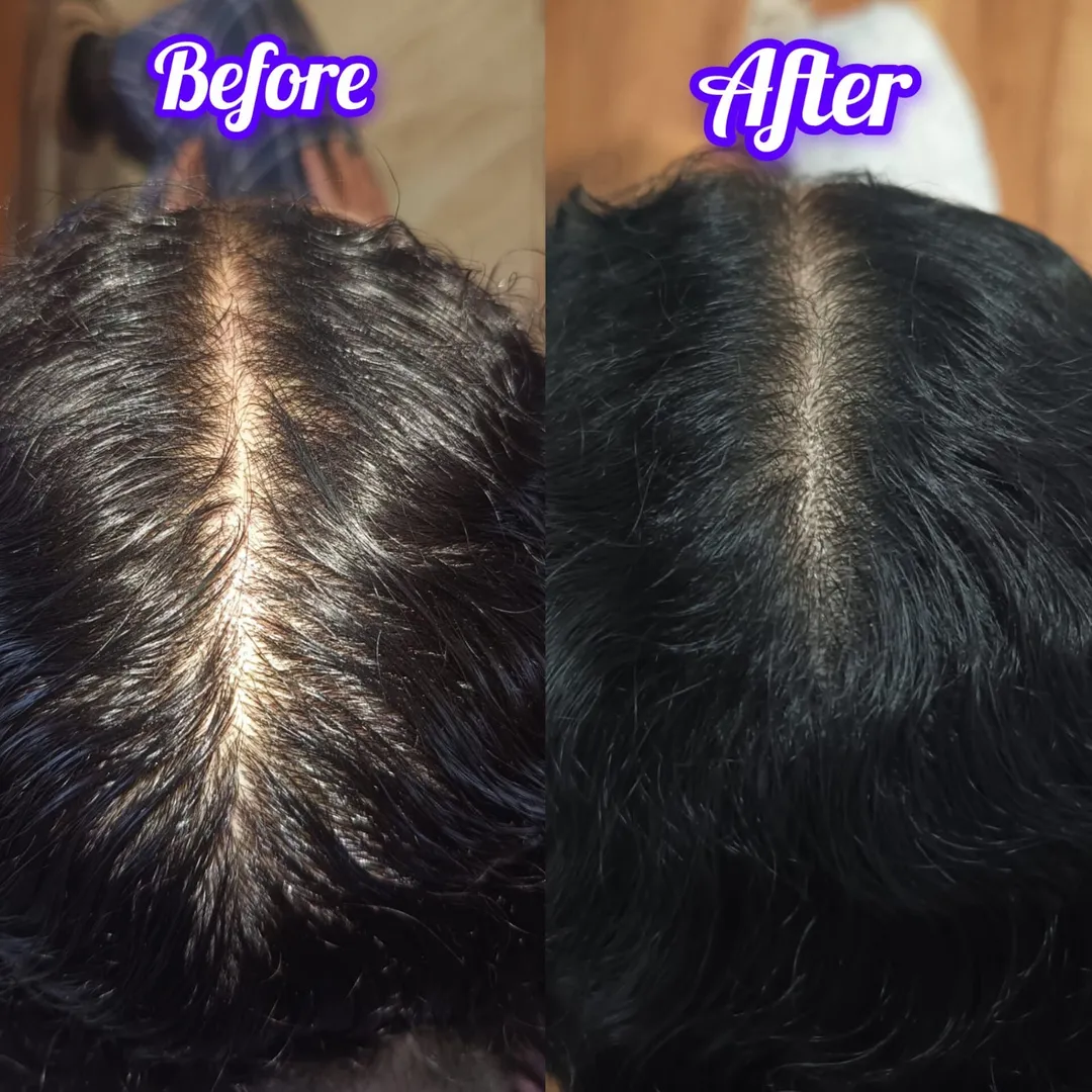 QR 678 Treatment with Dr.Drama Pen Treatment In Vashi