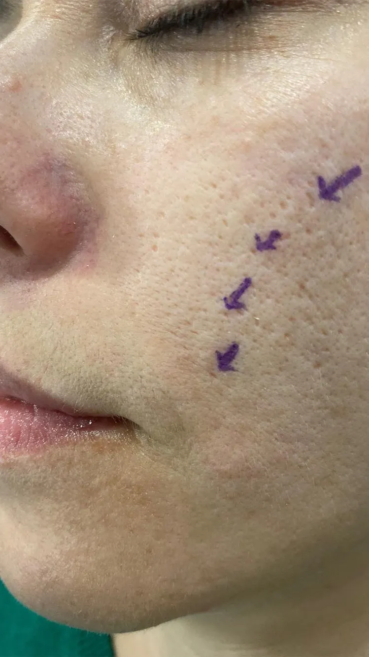 Punch excision and suturing for acne scars at Rakesh Reddy's Skin Clinic located conveniently in San