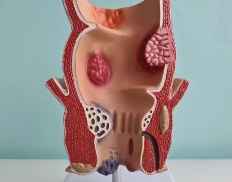 How to Select a Piles, Fissure and Fistula Specialist in Thane for Long-Term Relief