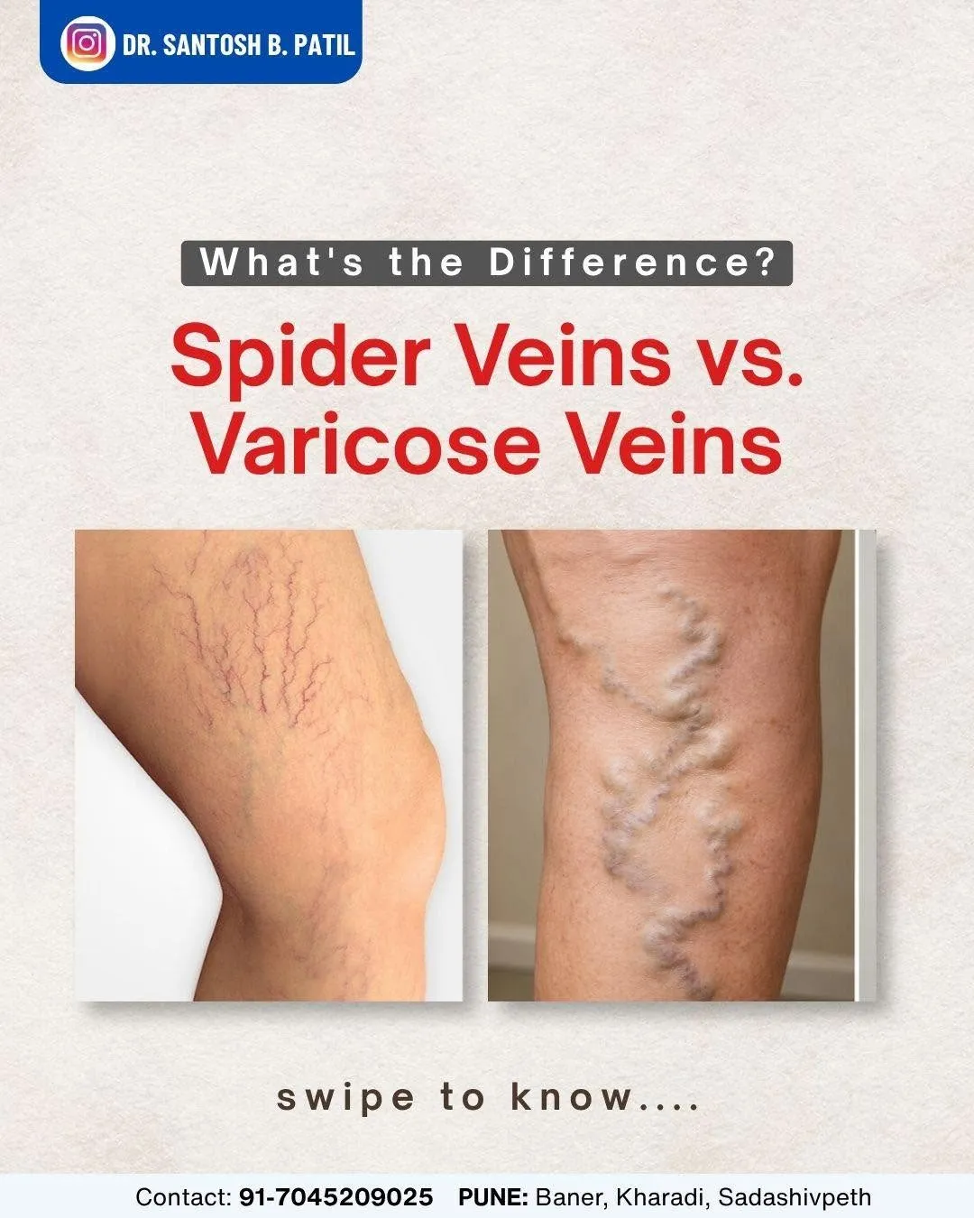 Spider veins and varicose veins may look similar, but they are not the same.Spider veins are usually...