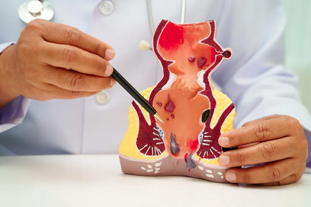 Fissure Specialist in Mazgaon Understanding Why Anal Pain Keeps Returning