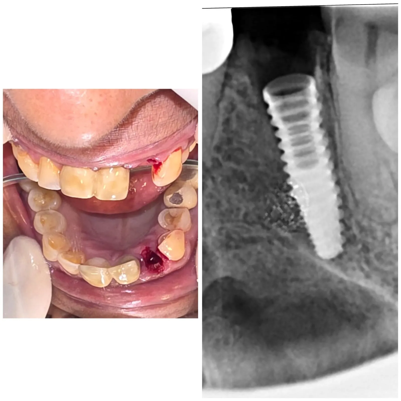 Immediate Dental Implants After Extraction: Who Is a Good Candidate?
