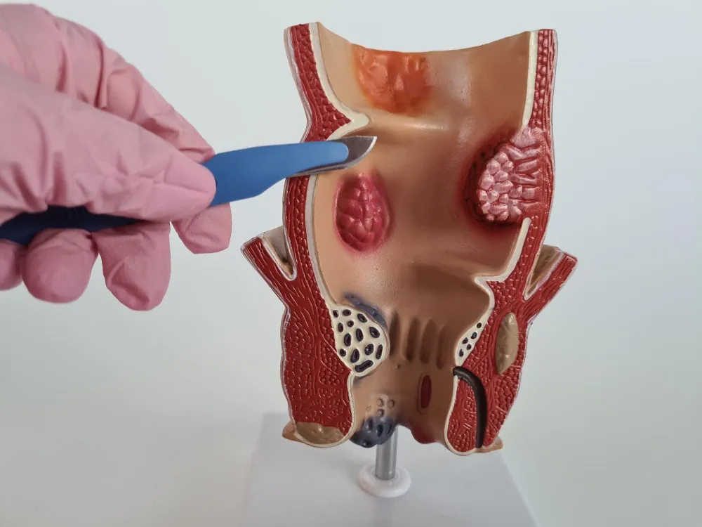 Piles, Fissure & Fistula Surgery: Know the Difference