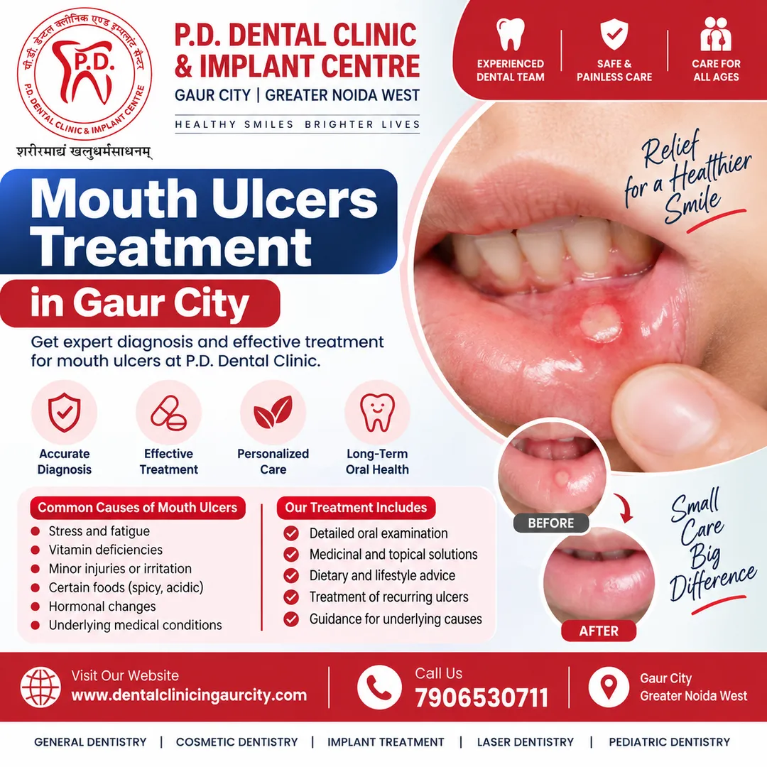 Mouth Ulcers Treatment in Gaur City | P.D. Dental Clinic
