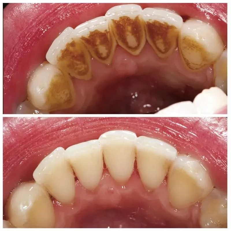 Tooth cleaning in vashi
