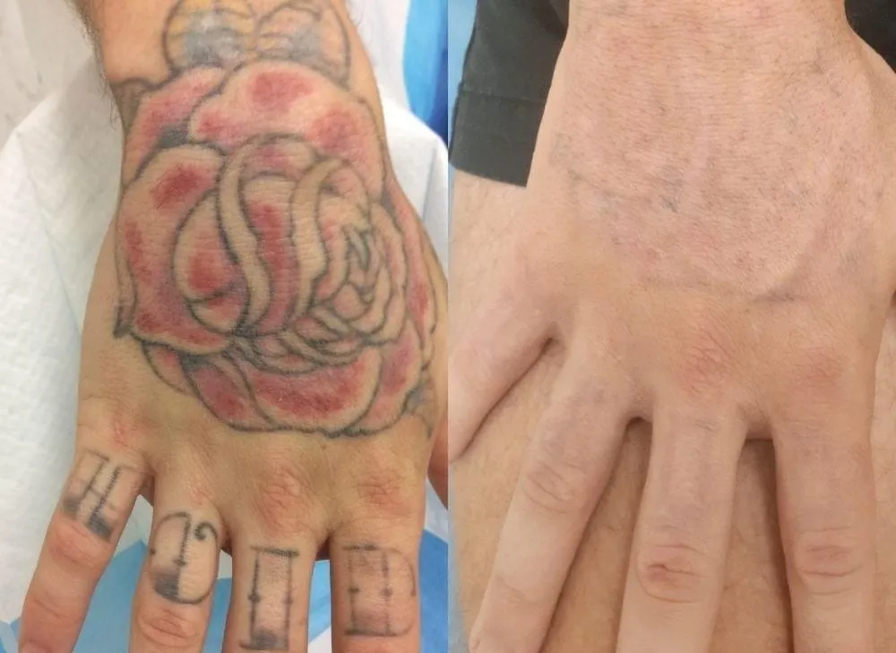 Best Tattoo removal In Vashi