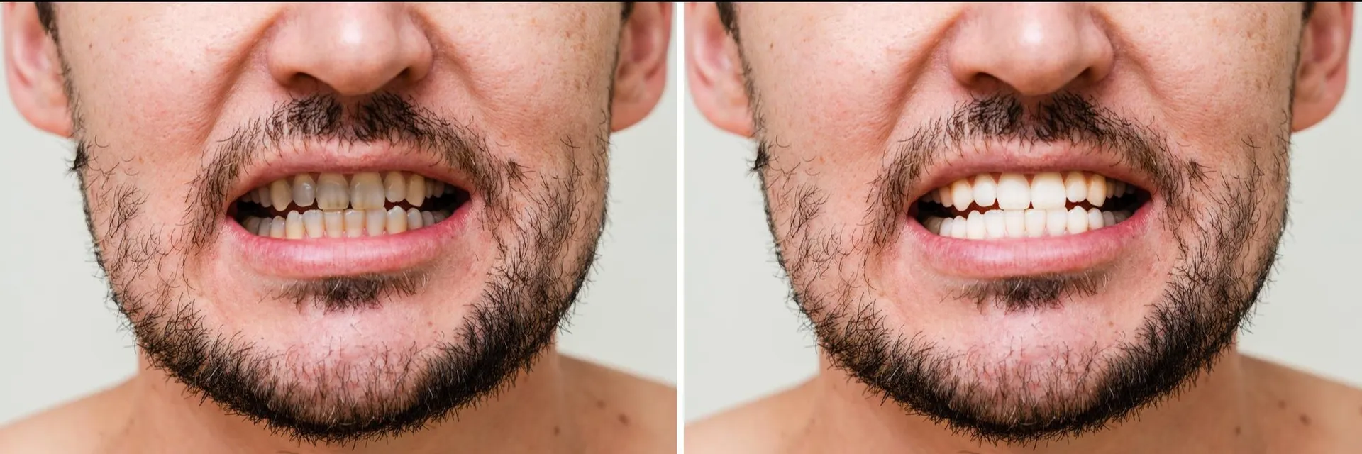 When Full Mouth Rehabilitation Becomes Necessary for Multiple Dental Problems