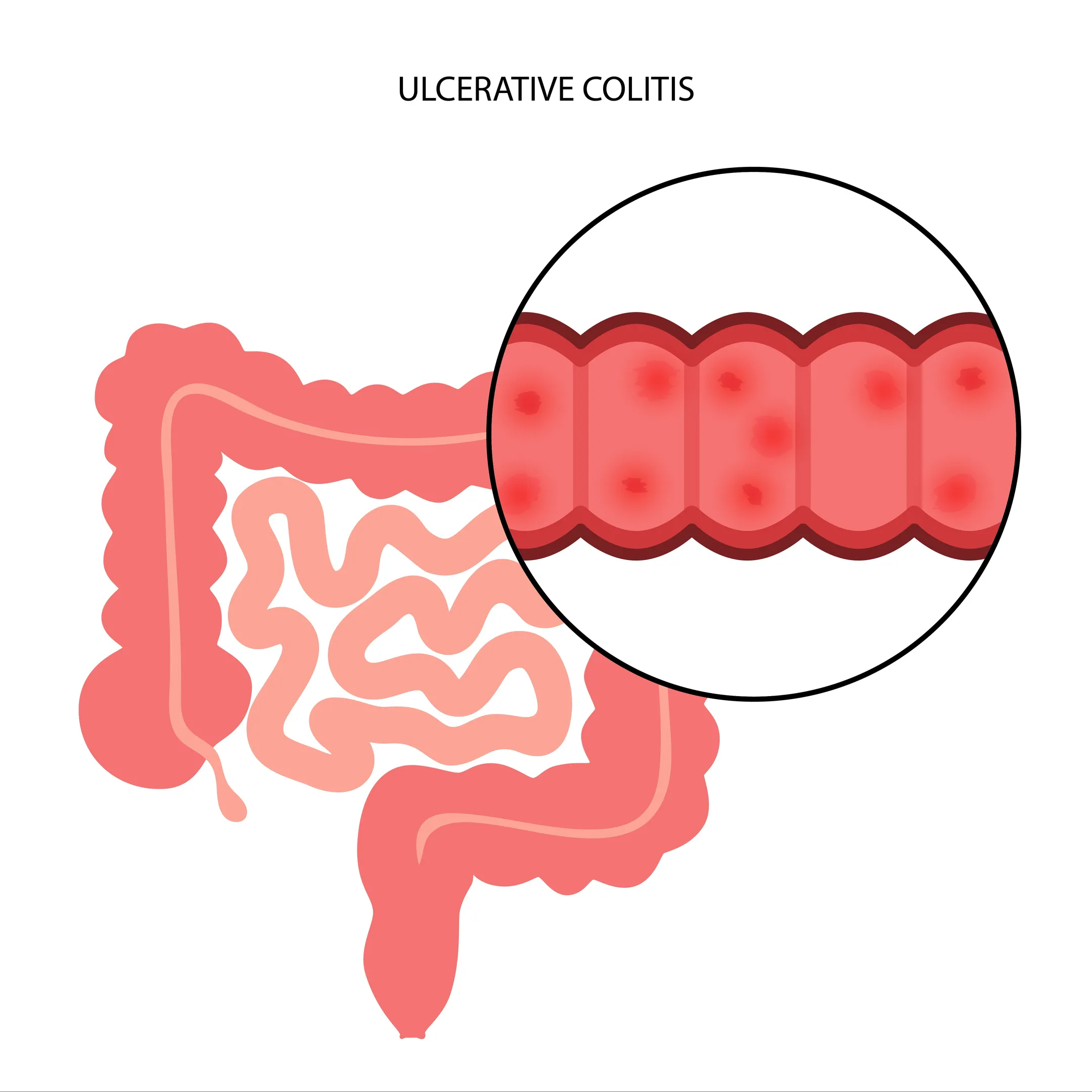 Ulcerative Colitis and Crohn’s Disease Specialist in Thane for Long-Term IBD Care