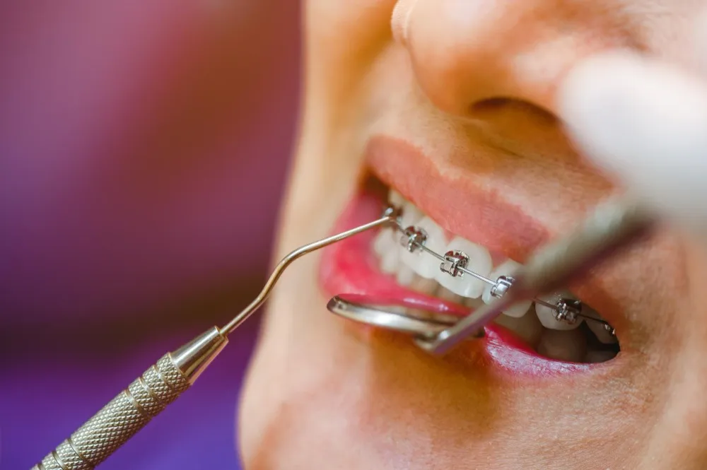 Clear Aligners: How Invisible Orthodontic Treatment Works