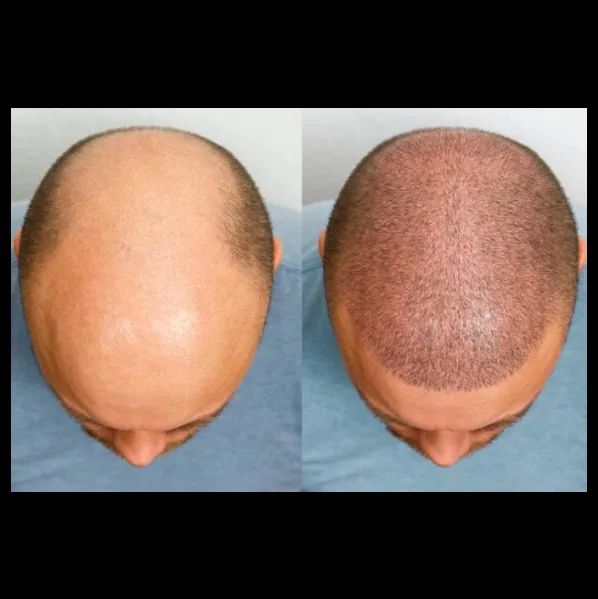 Best Hair Transplant In Vashi