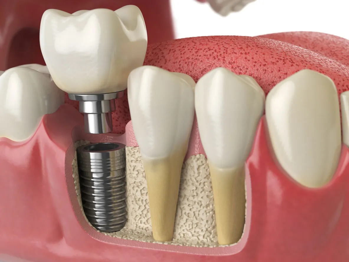 Best Dental implants In Vashi