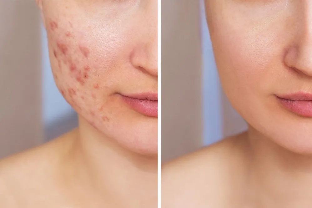 Acne Treatment Clinic in Borivali for Persistent Breakouts and Clearer Skin