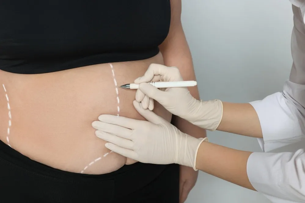 Liposuction for Stubborn Fat What It Can and Cannot Do